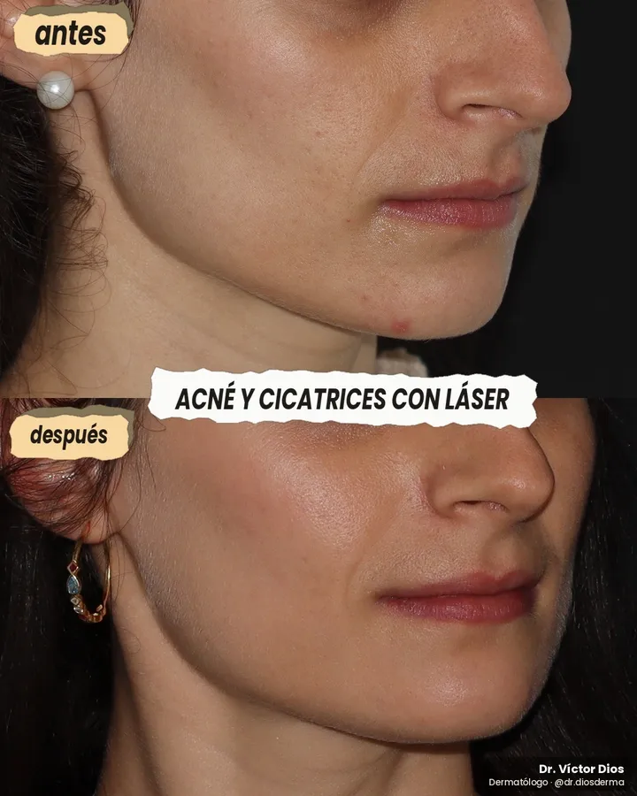 Antes y después de cicatrices de acné con láser de picosegundos