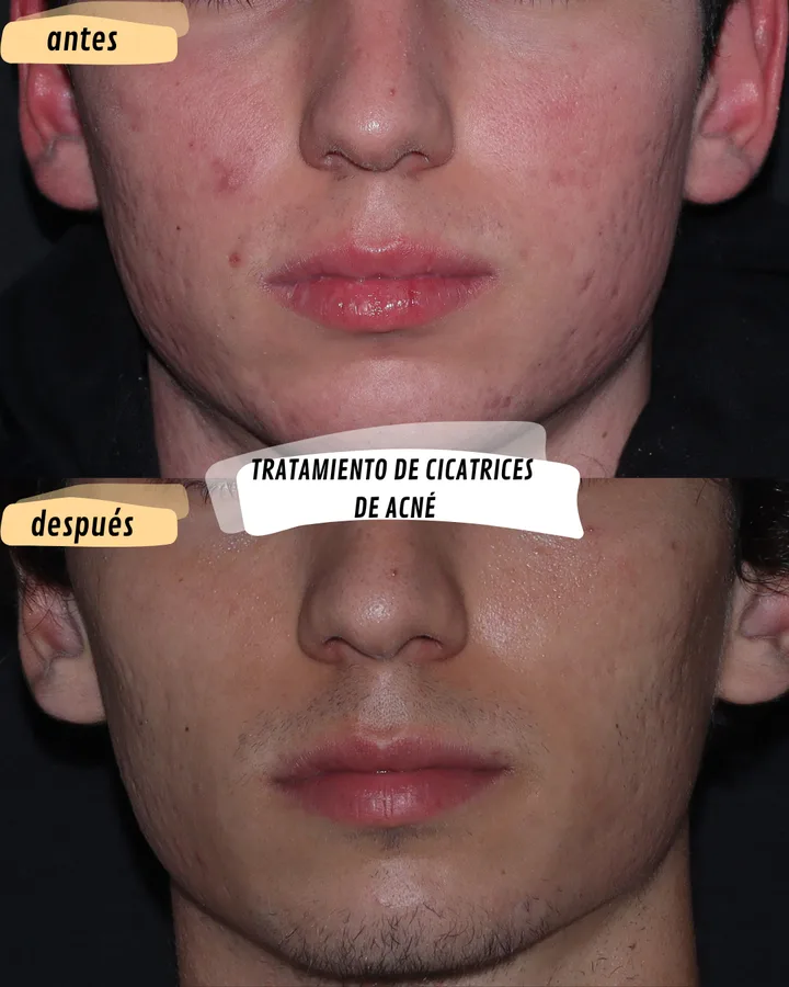 Antes y después de tratamiento de cicatrices de acné, vista frontal