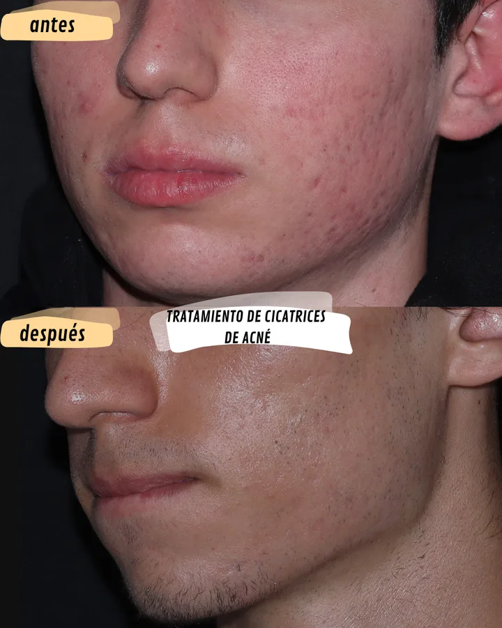 Antes y después de cicatrices de acné, lado izquierdo