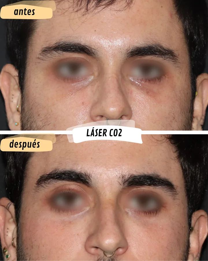 Antes y después de láser CO2 en párpados inferiores, vista frontal