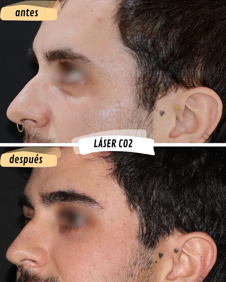 Antes y después de láser CO2 periocular, vista lateral
