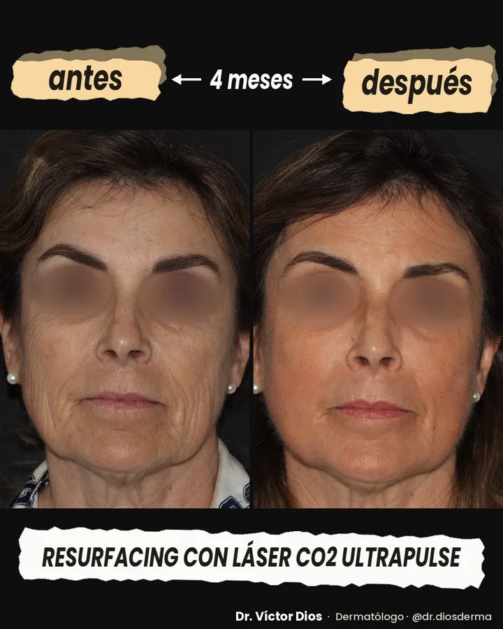 Antes y después de resurfacing con láser CO2 en Valencia, vista frontal