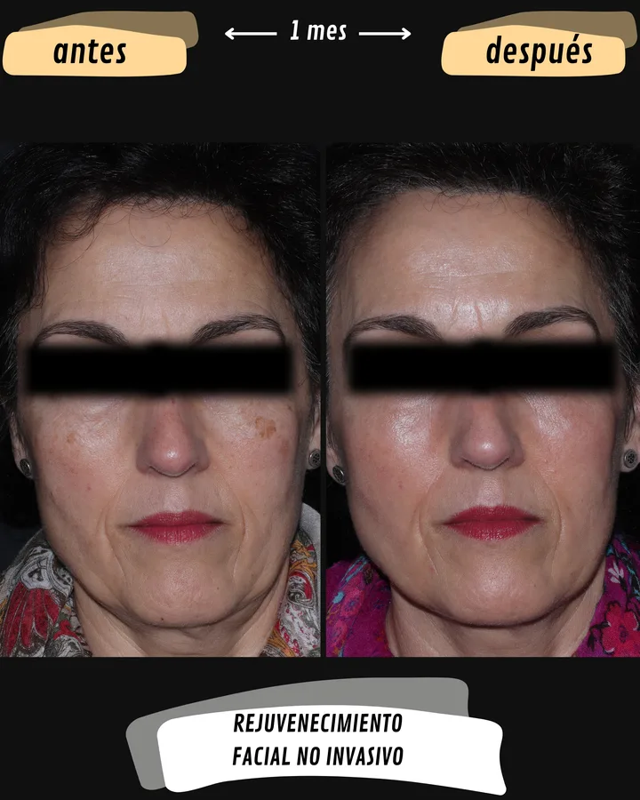 Antes y después de rejuvenecimiento facial no invasivo en Valencia, vista frontal