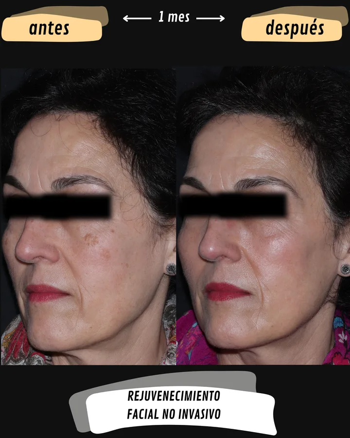 Antes y después de rejuvenecimiento facial con mejoría de manchas, vista lateral izquierda