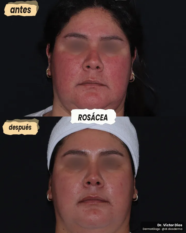 Antes y después de rosácea tratada con IPL y láser vascular, vista frontal