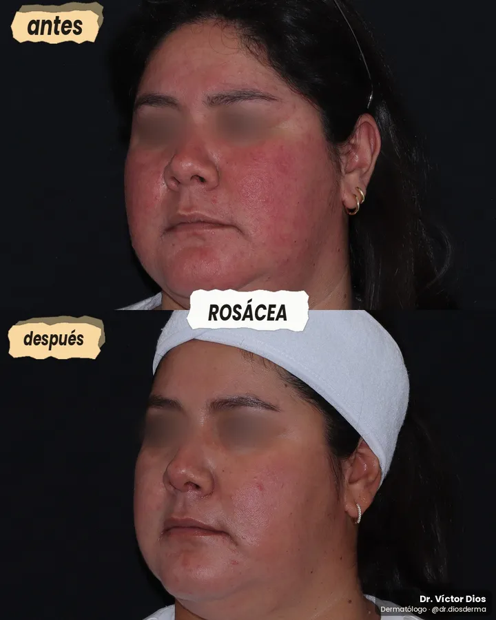 Antes y después de rosácea con láser, vista lateral izquierda