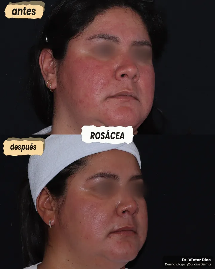 Antes y después de rosácea con láser, vista lateral derecha